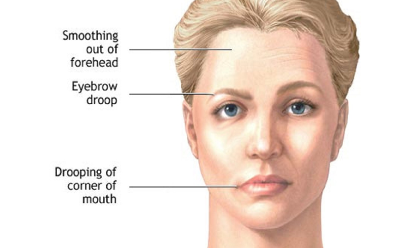 Bell’s Palsy Symptoms and Treatment